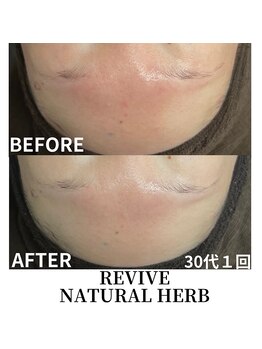 プレイス 太融寺店(PLACE)/ハーブピーリング