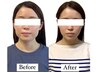 【圧倒的な小顔人気No.1】骨格美人へ 美容鍼×小顔矯正スペシャル ★60分