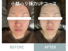 チル(Chill)/小顔ハリ弾力UPコース