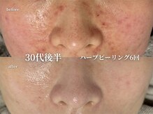 コウル 川西能勢口店(geoul)/肌質改善ニキビケアコース