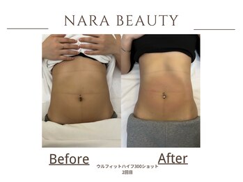 ナラビューティー(NARA BEAUTY)/お腹300s