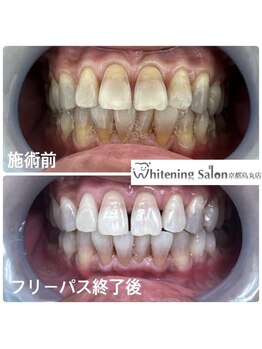 ホワイトニングサロン 京都烏丸店/ホワイトニング 施術例