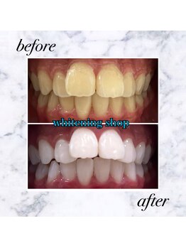 ホワイトニングショップ 岡山店/【岡山】美白ホワイトニング