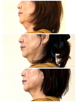 リンドール(RinDoll)/ダイエット/痩身/耳つぼ