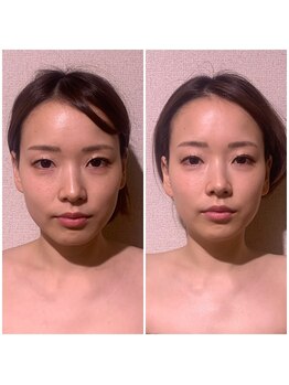 りっつ鍼灸院/１回で小顔＆人中短縮も！