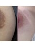 NEW ＜最新技術ローマピンクモニター40%0 FF＞・黒ずみ除去「乳輪・乳頭」
