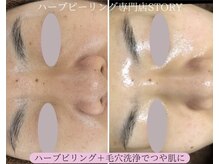 ストーリー 岐阜店(STORY)/ハーブピーリング専門店STORY