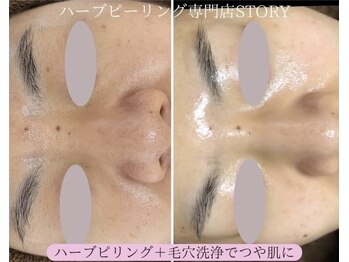 ストーリー 岐阜店(STORY)/ハーブピーリング専門店STORY