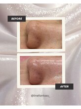 ラインファンタジー 武庫之荘店/毛穴吸引・毛穴洗浄