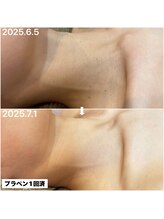 アンリミット(Unlimit)/小さいポツポツは1回で撲滅◎