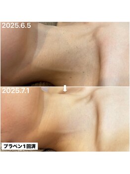 アンリミット(Unlimit)/小さいポツポツは1回で撲滅◎