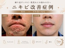 プリベンティブ ビューティー ティップス(Preventive Beauty Tips)