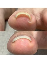 トイロ(toiro)/巻き爪補正