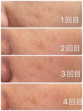 長寿鍼灸院 長寿整骨院/美容鍼25本の効果★毛穴改善