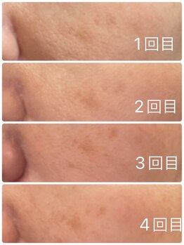 長寿鍼灸院 長寿整骨院/美容鍼25本の効果★毛穴改善