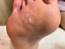 ビサンテ サロン/魚の目も熟練の角質ケアで綺麗-6