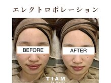 ティアム バイ テトテ 神戸三宮(TIAM by tetote)/エレクトロポレーション