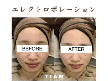 ティアム バイ テトテ 神戸三宮(TIAM by tetote)/エレクトロポレーション