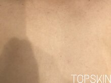 トップスキン 表参道(TOPSKIN)/剥離ありハーブTCLINE／5回施術