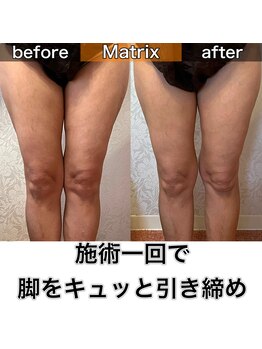 サロンデイジー(Salon Daisy)/Matrix痩身☆施術一回