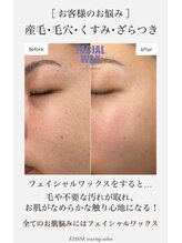 エリス(ELISSE)/産毛・毛穴・くすみ・ざらつき