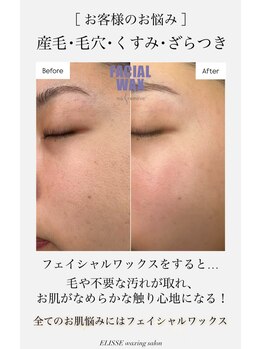 エリス(ELISSE)/産毛・毛穴・くすみ・ざらつき