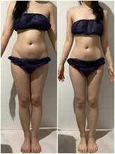 ルミナ(LUMINA)/痩身　Before→Afte