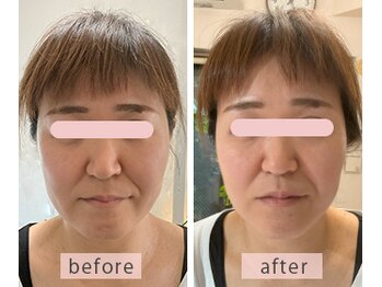 いとう鍼灸整体院 代官山恵比寿/美容鍼ビフォーアフター