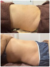 プリマプリート 島店/脂肪冷却＋全身筋膜