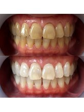 ワールドビューティー(World Beauty)/30代女性/ホワイトニング6回