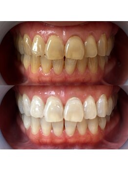 ワールドビューティー(World Beauty)/30代女性/ホワイトニング6回