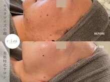 エイム(e.i.m)/30代：ホルモンニキビ/赤み/毛穴