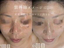 ウィハナ(wehana)の雰囲気（ピーリングを通して肌質改善/くすみ/毛穴/ニキビ/赤み）