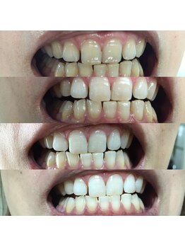 ティースクリーン(Teeth Clean)/セルフホワイトニング8回