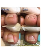 巻き爪補正店 西宮北口店/親指以外の巻き爪