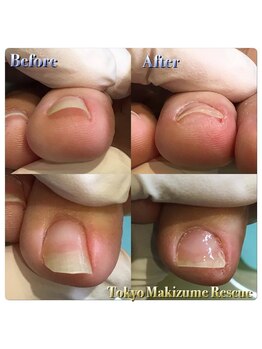 巻き爪補正店 西宮北口店/親指以外の巻き爪