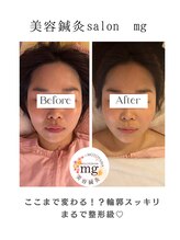 ミリグラム(mg)/【全身美容鍼灸９０分】