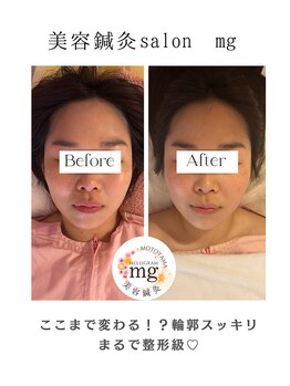 ミリグラム(mg)/【全身美容鍼灸９０分】