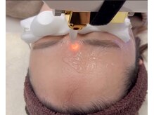 エンカフェサロン(en-cafe salon)/美眉毛脱毛《¥3000》