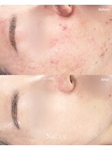 ユーエステティック(U AESTHETIC)/皮脂を除去する圧出ケア 