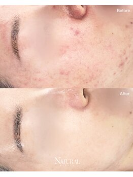 ユーエステティック(U AESTHETIC)/皮脂を除去する圧出ケア