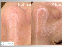 ミラー(MIRROR)/熊本市/毛穴洗浄/西熊本/くすみ