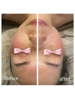 美温(mion)/透光白玉ピーリング