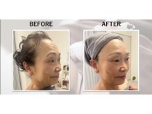 エクソソームフェイシャルコンテストで当店がグランプリを受賞！