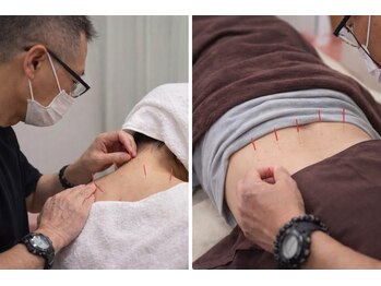 えとす整骨院 大倉山院の写真/詳しくお身体の痛みや不調についてお聞きしてお悩みの原因に直接アプローチする鍼灸施術で改善します。