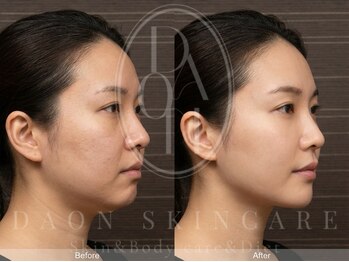 多穏スキンケア(skin care)/【人気No.1】ヴィショットV-shot