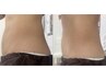 夏！脂肪コントロール術高周波WINBACK×4回に　塗るだけ筋膜リリースRE-FAS付