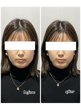 エンチャント(ENCHANT)/ウルトラお顔超音波リフト