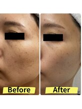 ルビア(Rubia)/ビフォーアフター　（30代）