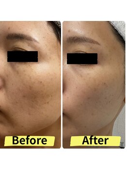 ルビア(Rubia)/ビフォーアフター　（30代）